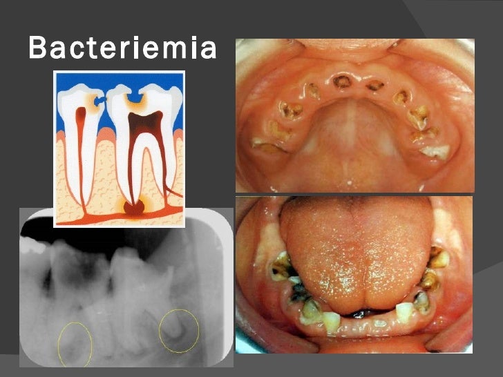 Caries y Endocarditis Bacteriana