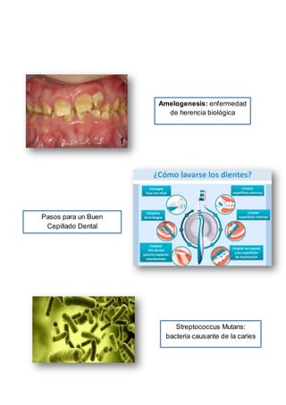 Amelogenesis: enfermedad
de herencia biológica
Pasos para un Buen
Cepillado Dental
Streptococcus Mutans:
bacteria causante de la caries
 