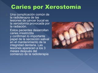  Una complicación común de 
la radioterapia de las 
lesiones de cáncer bucal es 
la xerostomía provocada por 
la radiación. 
 Estos pacientes desarrollan 
caries irrestrictita 
y confirman lo importante 
papel de la secreción salival 
en el mantenimiento de la 
integridad dentaria. Las 
lesiones aparecen a los 3 
meses después del 
comienzo de la radioterapia 
 