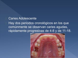  Caries Adolescente 
 Hay dos periodos cronológicos en los que 
comúnmente se observan caries agudas, 
rápidamente progresivas de 4-8 y de 11-18. 
 