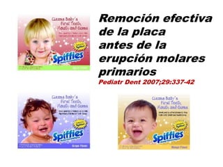 Remoción efectiva
de la placa
antes de la
erupción molares
primarios
Pediatr Dent 2007;29:337-42
 