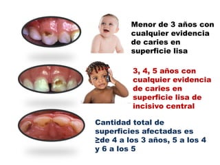 Menor de 3 años con
         cualquier evidencia
         de caries en
         superficie lisa

         3, 4, 5 años con
         cualquier evidencia
         de caries en
         superficie lisa de
         incisivo central

Cantidad total de
superficies afectadas es
≥de 4 a los 3 años, 5 a los 4
y 6 a los 5
 