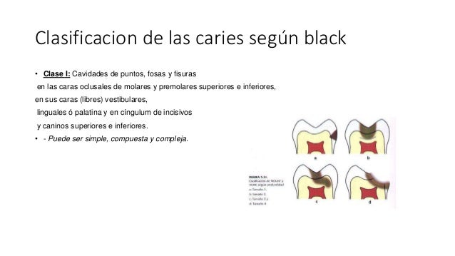 Caries bucal