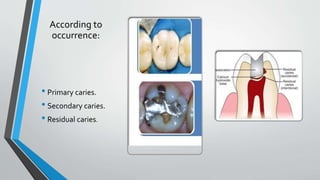 Caries Classification.pptx