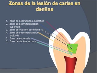 GenéticaEl índice CPOD de los hijos está significativamente correlacionado con el de los padres.Los cambios en el esmalte que produce la exposición a F en el agua no son suficientes para enmascarar la influencia de un factor genético.El factor genético representa el 40%.Klein H, Palmer CE. PublicHealthRep 1938; 53: 1353-64.Klein H. J Am DentAssoc 1946; 33: 735-43.Klein H. PublicHealthRep 1947; 62: 1247-53.