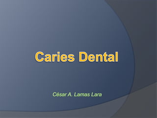 Caries Dental César A. Lamas Lara 