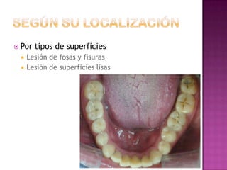  Por   tipos de superficies
    Lesión de fosas y fisuras
    Lesión de superficies lisas




                               11/1/2011   29
 