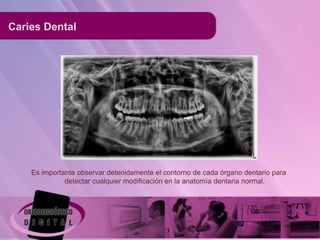 Caries Dental




    Es importante observar detenidamente el contorno de cada órgano dentario para
              detectar cualquier modificación en la anatomía dentaria normal.
 