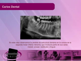 Caries Dental




     En este caso observamos la perdida de estructura dentaria en la corona de la
             segunda molar inferior derecha, que involucra parte de sus caras
                          mesial, oclusal, vestibular y lingual.
 