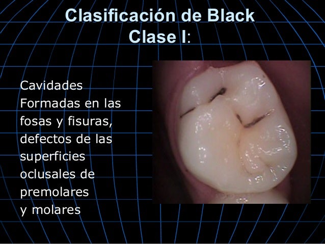 Caries dental