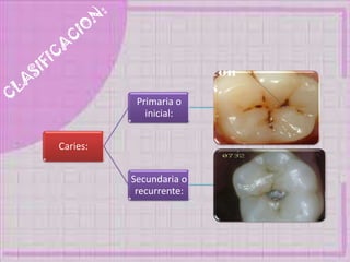 Caries:
Primaria o
inicial:
Secundaria o
recurrente:
 