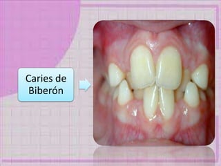 Caries de
Biberón
 