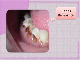 Caries
Rampante:
 