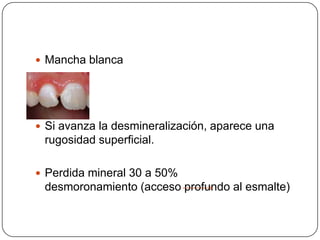  Mancha blanca
 Si avanza la desmineralización, aparece una
rugosidad superficial.
 Perdida mineral 30 a 50%
desmoronamiento (acceso profundo al esmalte)
 
