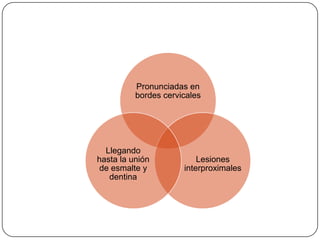 Pronunciadas en
bordes cervicales
Lesiones
interproximales
Llegando
hasta la unión
de esmalte y
dentina
 