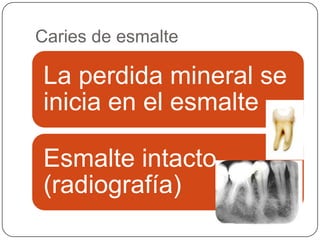 Caries de esmalte
La perdida mineral se
inicia en el esmalte
Esmalte intacto
(radiografía)
 