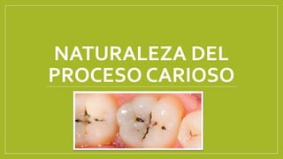 NATURALEZA DEL
PROCESO CARIOSO
 