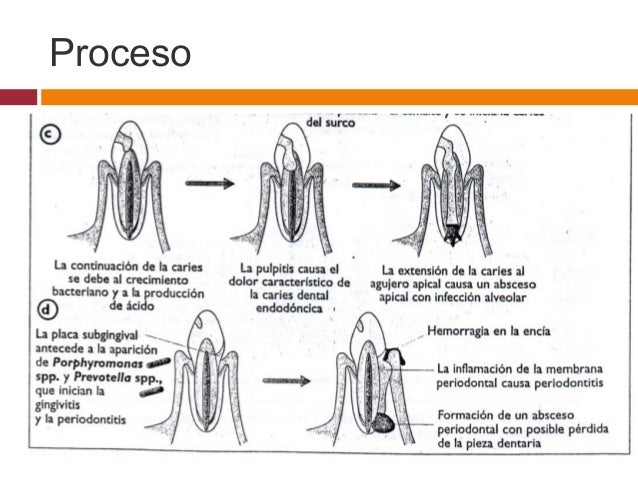 Odontologia I Bioquimica de Diente Caries Dental