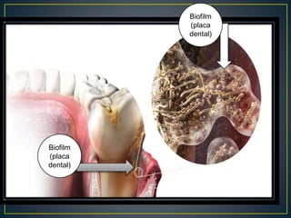 Biofilm
(placa
dental)
Biofilm
(placa
dental)
 