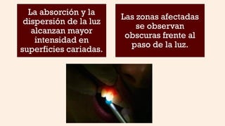 La absorción y la
dispersión de la luz
alcanzan mayor
intensidad en
superficies cariadas.
Las zonas afectadas
se observan
obscuras frente al
paso de la luz.
 