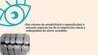 •Sus valores de sensibilidad y especificidad a
menudo superan los de la inspección visual y
radiografías de alerta mordible.
 