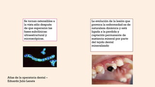 Se tornan ostensibles a
la vista sólo después
de que superaron las
fases subclínicas:
ultraestructural y
microscópicas.
La evolución de la lesión que
provoca la enfermedad es de
naturaleza dinámica y está
ligada a la perdida y
captación permanente de
sustancia mineral por parte
del tejido dental
mineralizado
Atlas de la operatoria dental –
Eduardo Julio Lanata
 