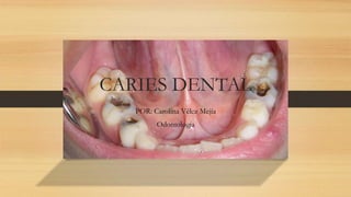 CARIES DENTAL
POR: Carolina Vélez Mejía
Odontología
 