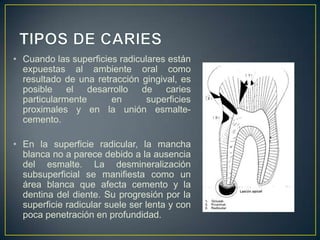 • Cuando las superficies radiculares están
expuestas al ambiente oral como
resultado de una retracción gingival, es
posible el desarrollo de caries
particularmente en superficies
proximales y en la unión esmalte-
cemento.
• En la superficie radicular, la mancha
blanca no a parece debido a la ausencia
del esmalte. La desmineralización
subsuperficial se manifiesta como un
área blanca que afecta cemento y la
dentina del diente. Su progresión por la
superficie radicular suele ser lenta y con
poca penetración en profundidad.
 