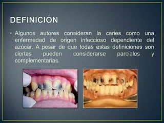 • Algunos autores consideran la caries como una
enfermedad de origen infeccioso dependiente del
azúcar. A pesar de que todas estas definiciones son
ciertas pueden considerarse parciales y
complementarias.
 
