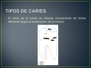 • El inicio de la caries se detecta clínicamente de forma
diferente según la localización de la misma.
 