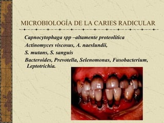 MICROBIOLOGÍA DE LA CARIES RADICULAR Capnocytophaga spp –altamente proteolítica Actinomyces viscosus, A. naeslundii, S. mutans, S. sanguis Bacteroides, Prevotella, Selenomonas, Fusobacterium, Leptotrichia. 