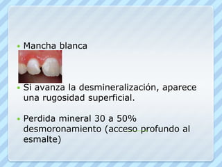 Caries de esmalte