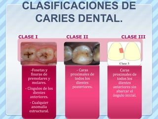 CLASIFICACIONES DE CARIES DENTAL.Según su localización (GreeneVardiman Black).