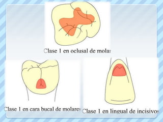 CLASE IV                                     CLASE V