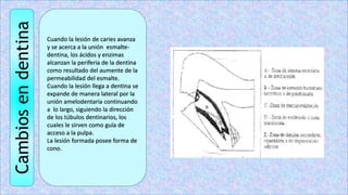 Cambios
en
dentina
Cuando la lesión de caries avanza
y se acerca a la unión esmalte-
dentina, los ácidos y enzimas
alcanzan la periferia de la dentina
como resultado del aumente de la
permeabilidad del esmalte.
Cuando la lesión llega a dentina se
expande de manera lateral por la
unión amelodentaria continuando
a lo largo, siguiendo la dirección
de los túbulos dentinarios, los
cuales le sirven como guía de
acceso a la pulpa.
La lesión formada posee forma de
cono.
 