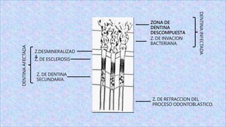ZONA DE
DENTINA
DESCOMPUESTA
Z. DE INVACION
BACTERIANA.
Z.DESMINERALIZAD
A
Z, DE ESCLEROSIS
Z, DE DENTINA
SECUNDARIA.
DENTINA
AFECTADA
DENTINA
INFECTADA
Z. DE RETRACCION DEL
PROCESO ODONTOBLASTICO.
 