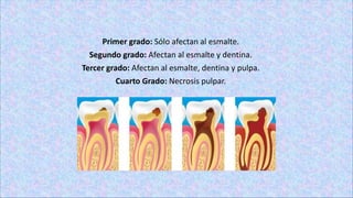 Primer grado: Sólo afectan al esmalte.
Segundo grado: Afectan al esmalte y dentina.
Tercer grado: Afectan al esmalte, dentina y pulpa.
Cuarto Grado: Necrosis pulpar.
 