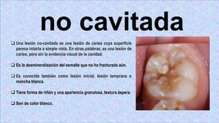 no cavitada
 Una lesión no-cavitada es una lesión de caries cuya superficie
parece intacta a simple vista. En otras palabras, es una lesión de
caries, pero sin la evidencia visual de la cavidad.
 Es la desmineralización del esmalte que no ha fracturado aún.
 Es conocida también como lesión inicial, lesión temprana o
mancha blanca.
 Tiene forma de riñón y una apariencia granulosa, textura áspera.
 Son de color blanco.
 