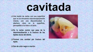  Una lesión de caries con una superficie
que no se encuentra macroscópicamente
intacta, con una discontinuidad o
abertura clara en la superficie,
perceptible a la vista o el tacto.
 Es la caries común que pasa de la
desmineralización a la fractura de los
tejidos duros del diente.
 Forman una cavidad por fractura del
tejido.
 Son de color negro o marrón.
cavitada
 
