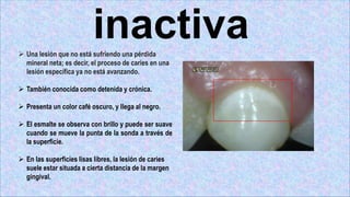 inactiva
 Una lesión que no está sufriendo una pérdida
mineral neta; es decir, el proceso de caries en una
lesión específica ya no está avanzando.
 También conocida como detenida y crónica.
 Presenta un color café oscuro, y llega al negro.
 El esmalte se observa con brillo y puede ser suave
cuando se mueve la punta de la sonda a través de
la superficie.
 En las superficies lisas libres, la lesión de caries
suele estar situada a cierta distancia de la margen
gingival.
 
