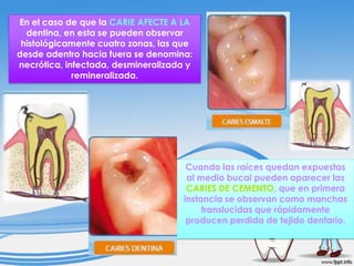 En el caso de que la CARIE AFECTE A LA
dentina, en esta se pueden observar
histológicamente cuatro zonas, las que
desde adentro hacia fuera se denomina:
necrótica, infectada, desmineralizada y
remineralizada.

Cuando las raíces quedan expuestas
al medio bucal pueden aparecer las
CARIES DE CEMENTO, que en primera
instancia se observan como manchas
translucidas que rápidamente
producen perdida de tejido dentario.

 