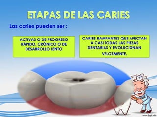 Las caries pueden ser :
ACTIVAS O DE PROGRESO
RÁPIDO, CRÓNICO O DE
DESARROLLO LENTO

CARIES RAMPANTES QUE AFECTAN
A CASI TODAS LAS PIEZAS
DENTARIAS Y EVOLUCIONAN
VELOZMENTE.

 