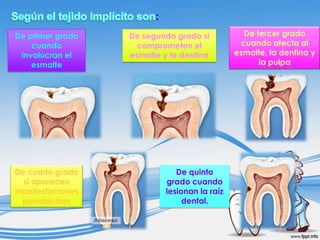 :
De primer grado
cuando
involucran el
esmalte

De cuarto grado
si aparecen
manifestaciones
periapicales

De segundo grado si
comprometen el
esmalte y la dentina

De quinto
grado cuando
lesionan la raíz
dental.

De tercer grado
cuando afecta al
esmalte, la dentina y
la pulpa

 
