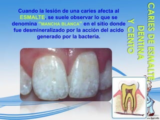 Cuando la lesión de una caries afecta al
ESMALTE, se suele observar lo que se
denomina “MANCHA BLANCA” en el sitio donde
fue desmineralizado por la acción del acido
generado por la bacteria.

 