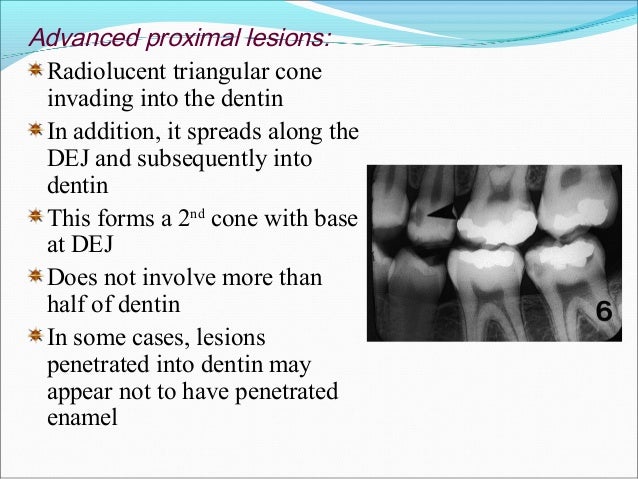 Mach Band Effect In Dentistry