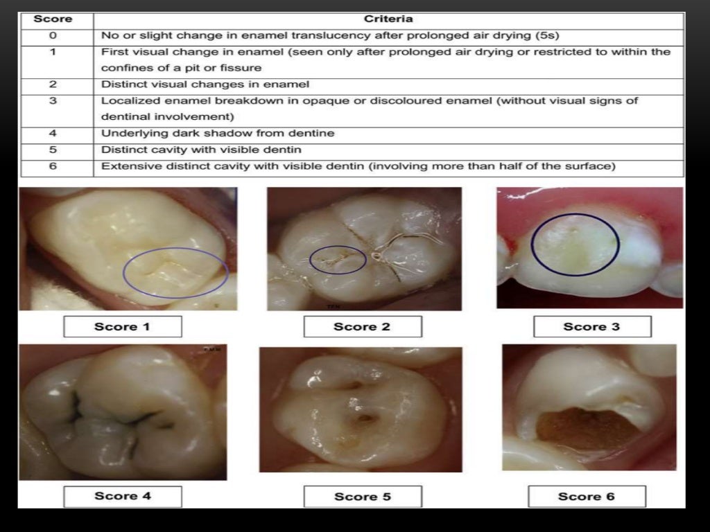 Caries diagnosis