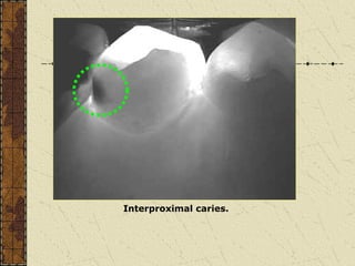 CARIES DIAGNOSIS-- Dr Thejokrishna P.ppt