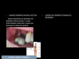 • CARIES CEMENTO AGUDA O ACTIVA
Suele presentarse en pacientes con
diabettes mellitus de tipo 1 y otras
enfermedades sistemicas o lcales que
favorecen la retraccion gingival
• CARIES DE CEMENTO CRONICA O
DETENIDA
ALVARO LIMACHI PERALTA
 