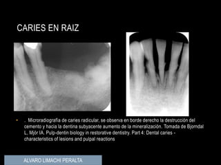 • . Microradiografía de caries radicular, se observa en borde derecho la destrucción del
cemento y hacia la dentina subyacente aumento de la mineralización. Tomada de Bjorndal
L, Mjör IA. Pulp-dentin biology in restorative dentistry. Part 4: Dental caries -
characteristics of lesions and pulpal reactions
CARIES EN RAIZ
ALVARO LIMACHI PERALTA
 