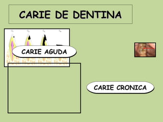CARIE DE DENTINA


CARIE AGUDA




              CARIE CRONICA
 